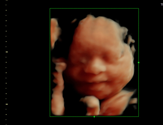 3D ultrasound image at 29 weeks
